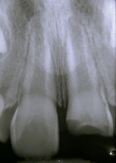 Apex « ouverts » (> 1 mm) de dents immatures. La revascularisationx de l’espace pulpaire peut éventuellement se faire.