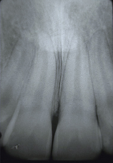 Apex « fermés » (< 1 mm) de dents matures. La revascularisation de l’espace pulpaire n’a pratiquement aucune chance de se faire.