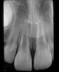 Radiographie de la 11 immature, 1 mois après réimplantation.