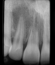 Radiographie de 11, 12 mois après réimplantation. La revascularisation de 11 a eu lieu, mais avec pénétration de tissu osseux accompagné de desmodonte à l’intérieur de l’espace pulpaire.