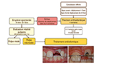 Traction orthodontique.