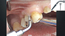 Fig. 2 : Schéma montrant le positionnement de la lame d’extraction.