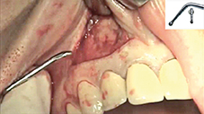 Fig. 3 : Résection apicale à l’aide d’un embout diamanté SL1.