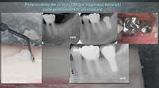 Fig. 4 : Prélèvement de copeaux osseux dans la zone ramique et comblement d’un défaut osseux avant implantation.