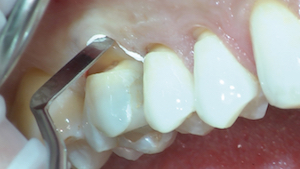 8 - On peut noter un aspect plus favorable de la gencive en postopératoire sur les dents isolées par une digue latex (14, 15) en comparaison avec celle isolée par un fil Téflon® (16).