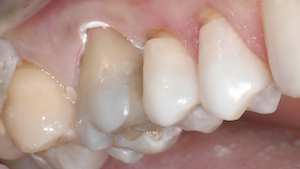 2 - La dentine est nettoyée à l’aide d’une fraise bague rouge. Un chanfrein est créé au niveau amélaire. De manière exceptionnelle, une effraction pulpaire était présente avant intervention. Elle a été gérée par la mise en place de ciment à base de silicate tricalcique (Totalfill®).