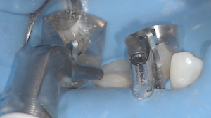 1 - Après avoir protégé les dents adjacentes par des matrices, un sablage à l’alumine 27 microns est effectué au niveau du moignon afin d’éliminer les pollutions de surface.